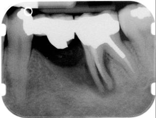 x-ray of lower-left teeth