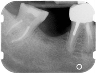 x-ray of lower-right teeth