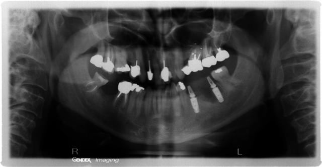 x-ray of whole mouthful of teeth